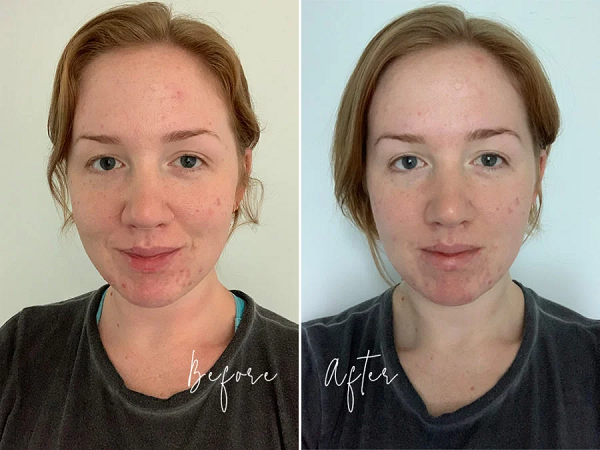 Trial Tribe reviews: Clear Skin Tonic