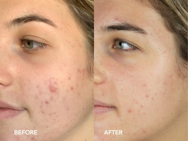 ELIZ - Clear Skin Trial Tribe Participant